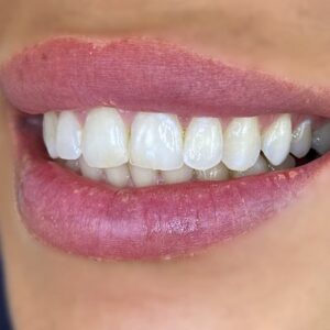 composite bonding smile17 before edentist bentleigh