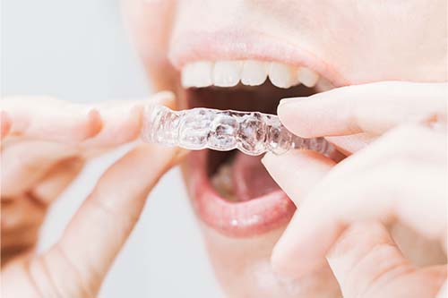 invisalign dentist