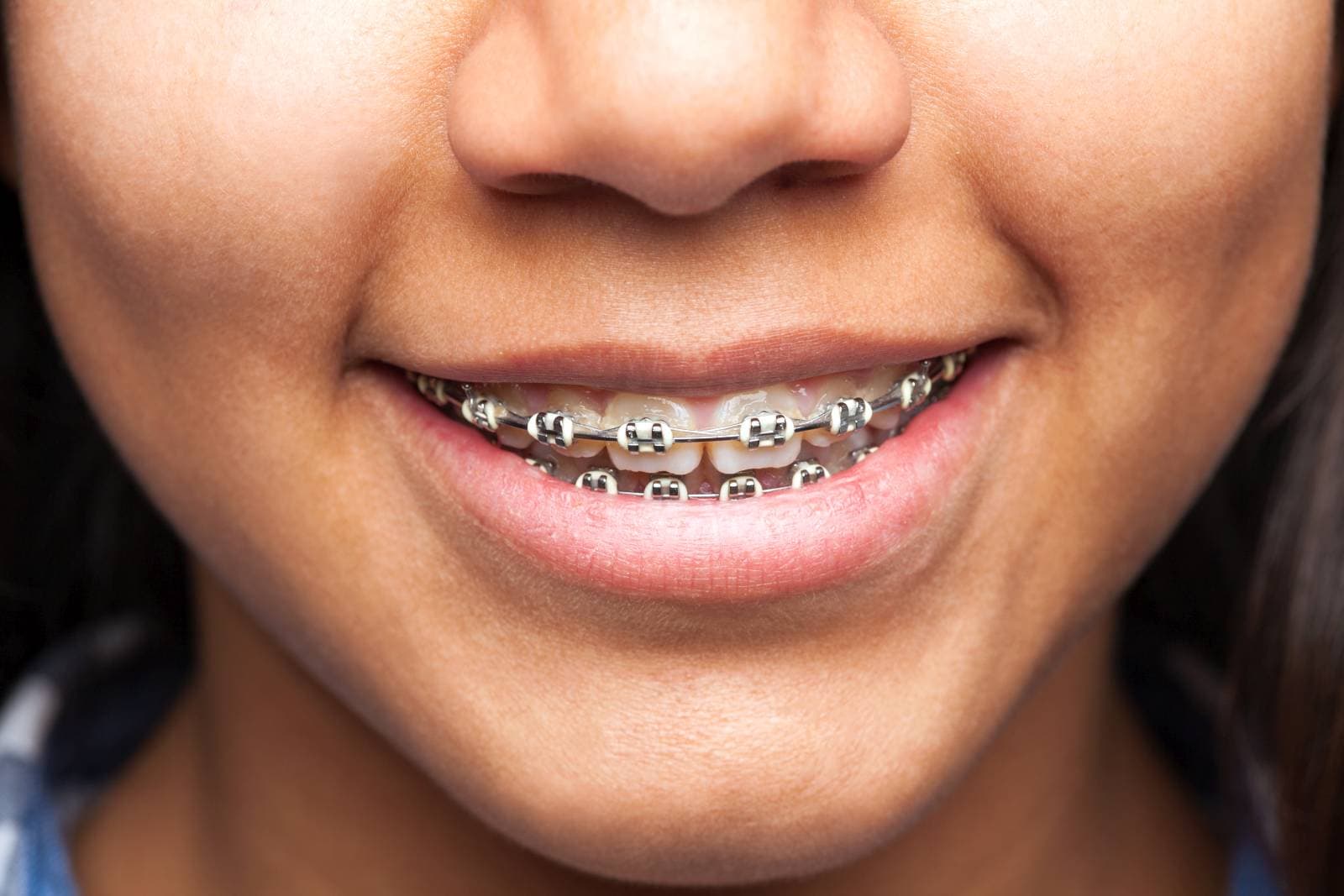 latin girl's mouth with brackets